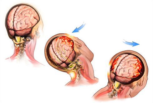 Сотрясение мозга