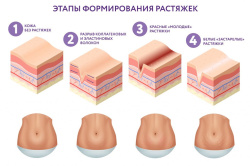 Растяжки. Почему они появляются?